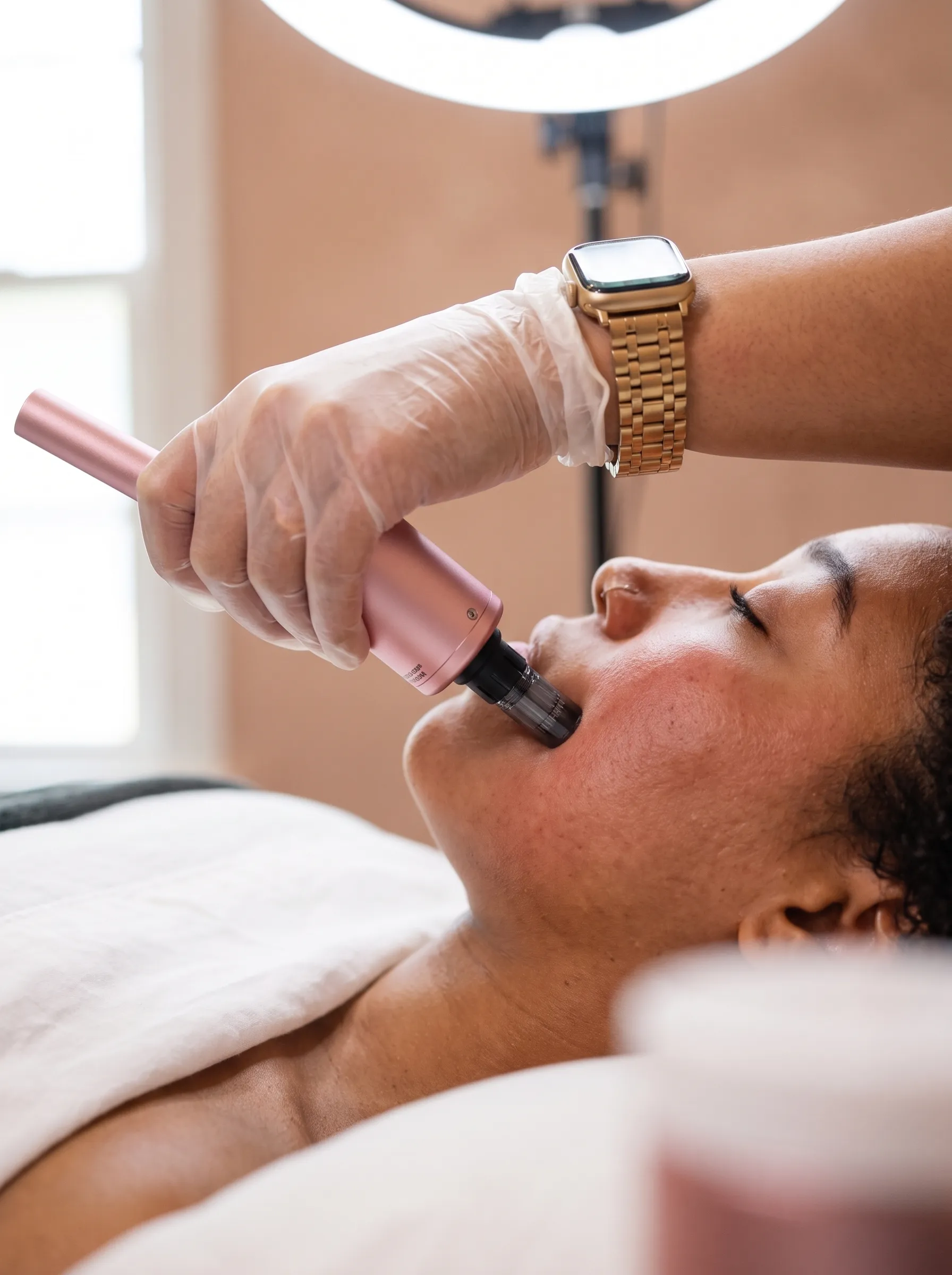 Procell microchanneling device in use at KIAMO Skin studio, depth-adjusted for acne scar revision on melanin-rich skin