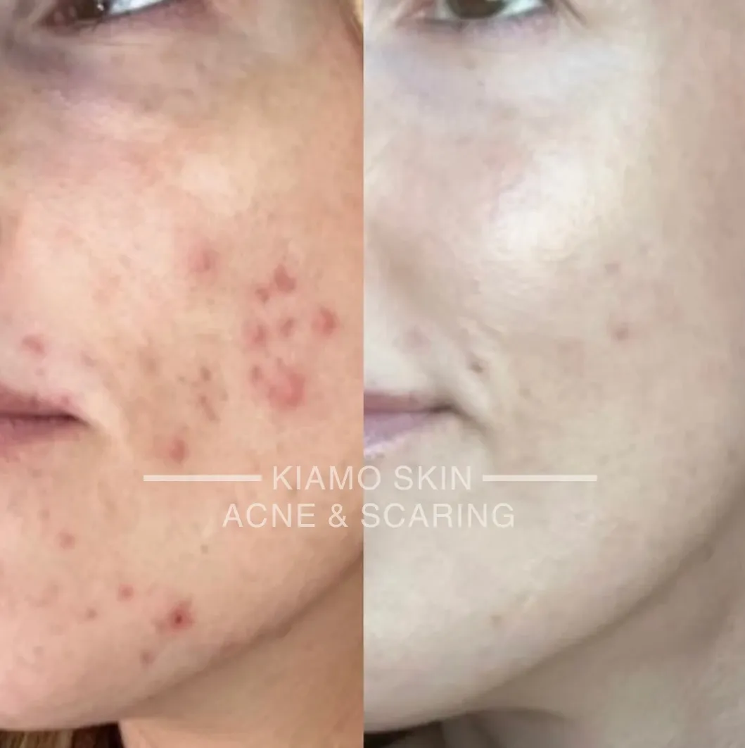 Before and after Procell Microchanneling at KIAMO Skin in Mission Hills - acne scarring softened over three sessions.