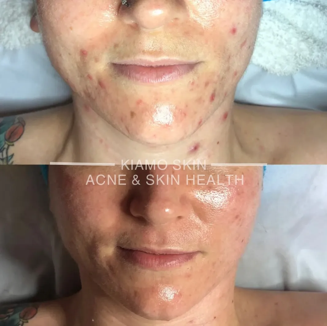 Before and after acne treatment at KIAMO Skin in Mission Hills - active cystic acne cleared over six corrective sessions.