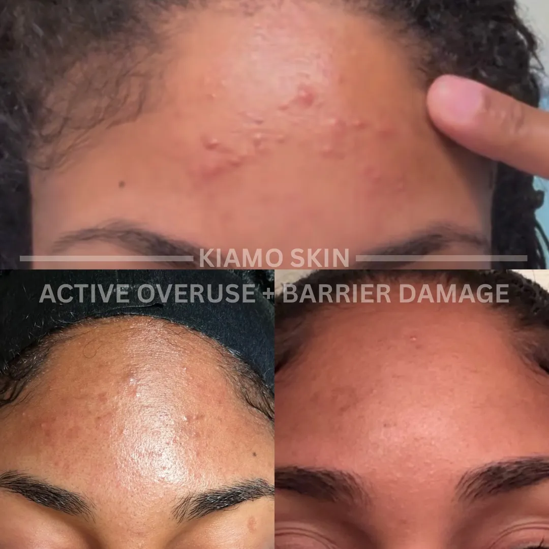Before and after DMK Enzyme Therapy at KIAMO Skin in Mission Hills - barrier repair after active product overuse over four sessions.