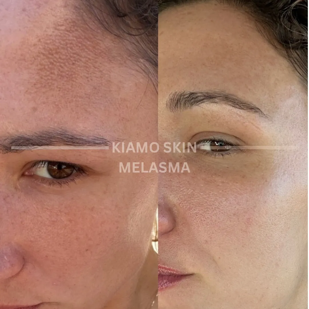 Before and after melasma treatment at KIAMO Skin in Mission Hills - four Lira Chemical Peel sessions across four months.